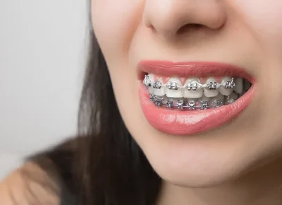 Braces11